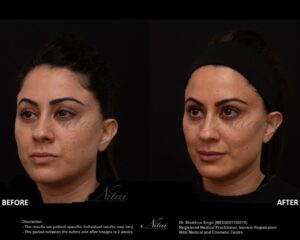 Dermal Treatment BA Image