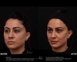 Dermal Treatment BA Image