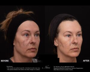 Dermal Treatment BA Image