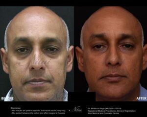 Dermal Treatment BA Image