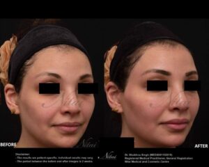 Dermal Treatment BA Image