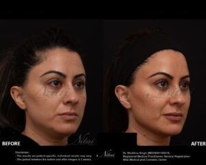 Dermal Treatment BA Image