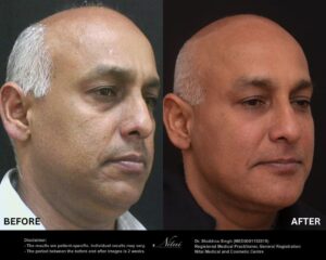 Dermal Treatment BA Image