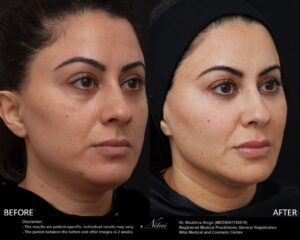 Dermal Treatment BA Image