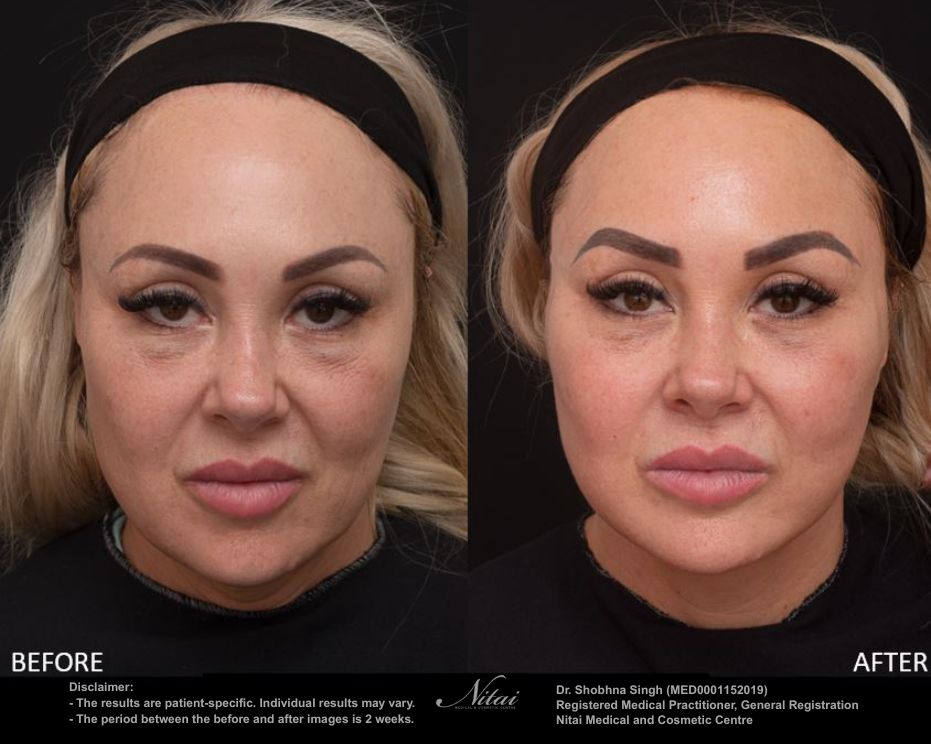 Dermal Treatment BA Image
