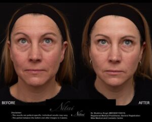 Dermal Treatment BA Image