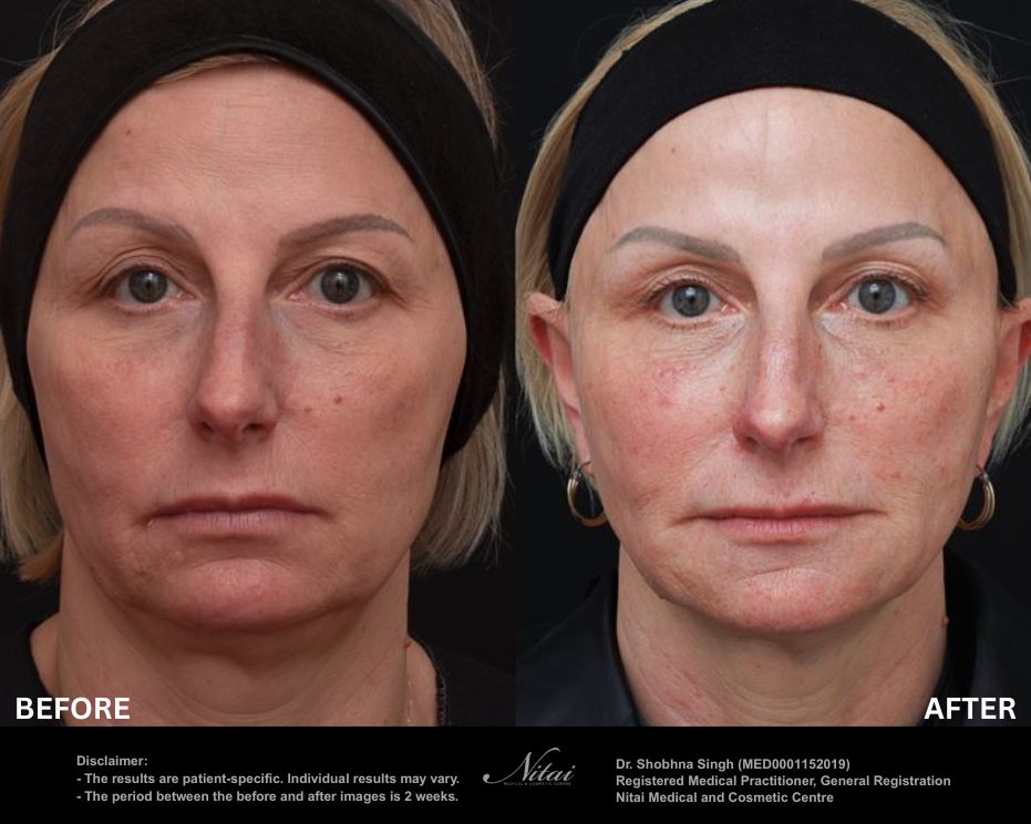 Dermal Treatment BA Image