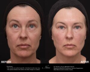 Dermal Treatment BA Image