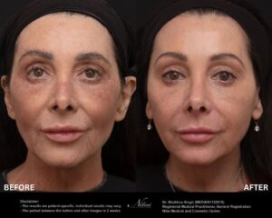 Dermal Treatment BA Image