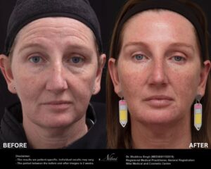 Dermal Treatment BA Image