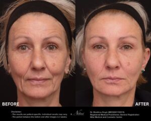 Dermal Treatment BA Image