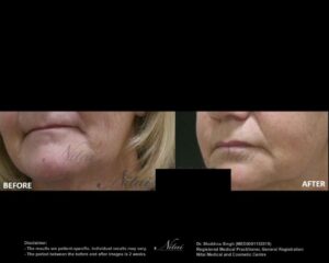 Dermal Treatment BA Image