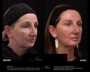 Dermal Treatment BA Image