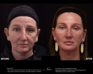 Dermal Treatment BA Image