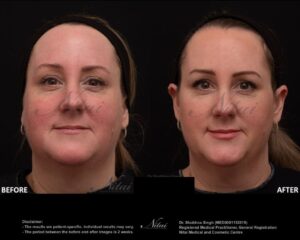 Dermal Treatment BA Image