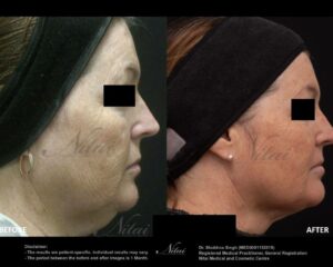 Chin Volume Treatment BA Image