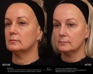 Chin Volume Treatment BA Image