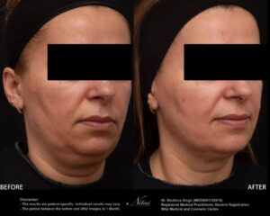 Chin Volume Treatment BA Image