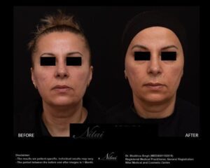Chin Volume Treatment BA Image