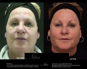 Chin Volume Treatment BA Image