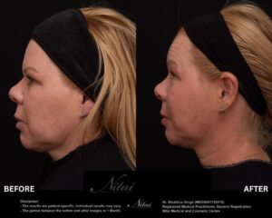 Chin Volume Treatment BA Image