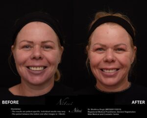 Chin Volume Treatment BA Image