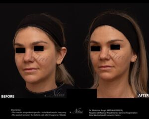 Chin Volume Treatment BA Image