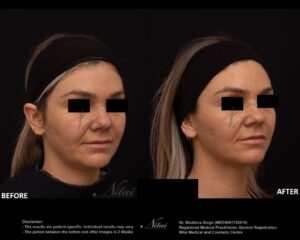 Chin Volume Treatment BA Image