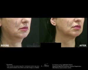 Chin Volume Treatment BA Image