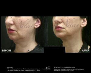 Chin Volume Treatment BA Image