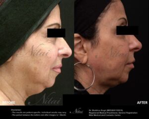 Chin Volume Treatment BA Image