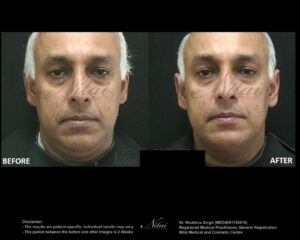 Chin Volume Treatment BA Image