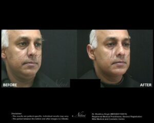 Chin Volume Treatment BA Image
