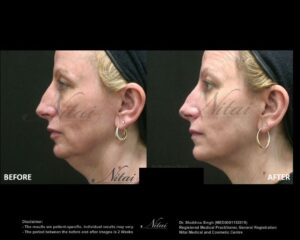 Chin Volume Treatment BA Image