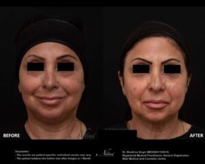 Chin Volume Treatment BA Image