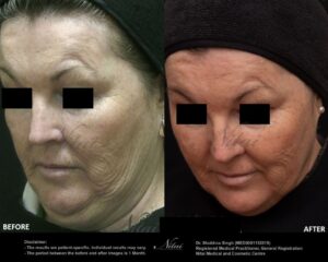 Chin Volume Treatment BA Image