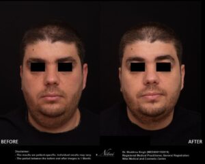Chin Volume Treatment BA Image