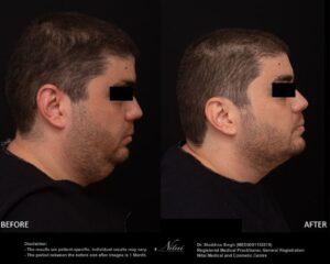 Chin Volume Treatment BA Image