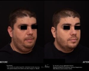 Chin Volume Treatment BA Image
