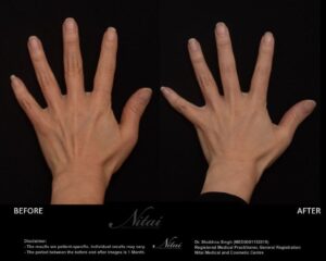 Hand Rejuventation Treatment BA Image