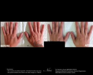 Hand Rejuventation Treatment BA Image