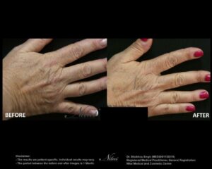 Hand Rejuventation Treatment BA Image