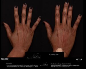 Hand Rejuventation Treatment BA Image