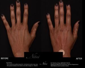 Hand Rejuventation Treatment BA Image
