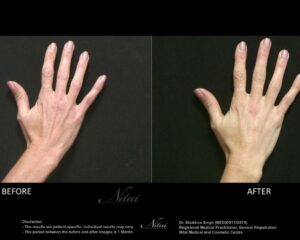 Hand Rejuventation Treatment BA Image