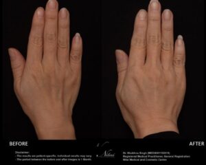 Hand Rejuventation Treatment BA Image
