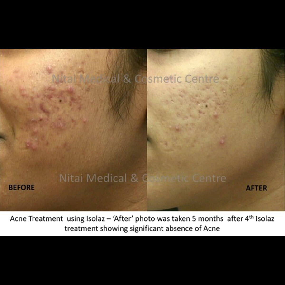 Isolaz Acne Treatment