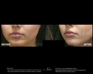 Lip Volume Treatment BA Image