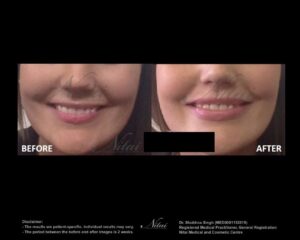 Lip Volume Treatment BA Image
