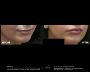 Lip Volume Treatment BA Image